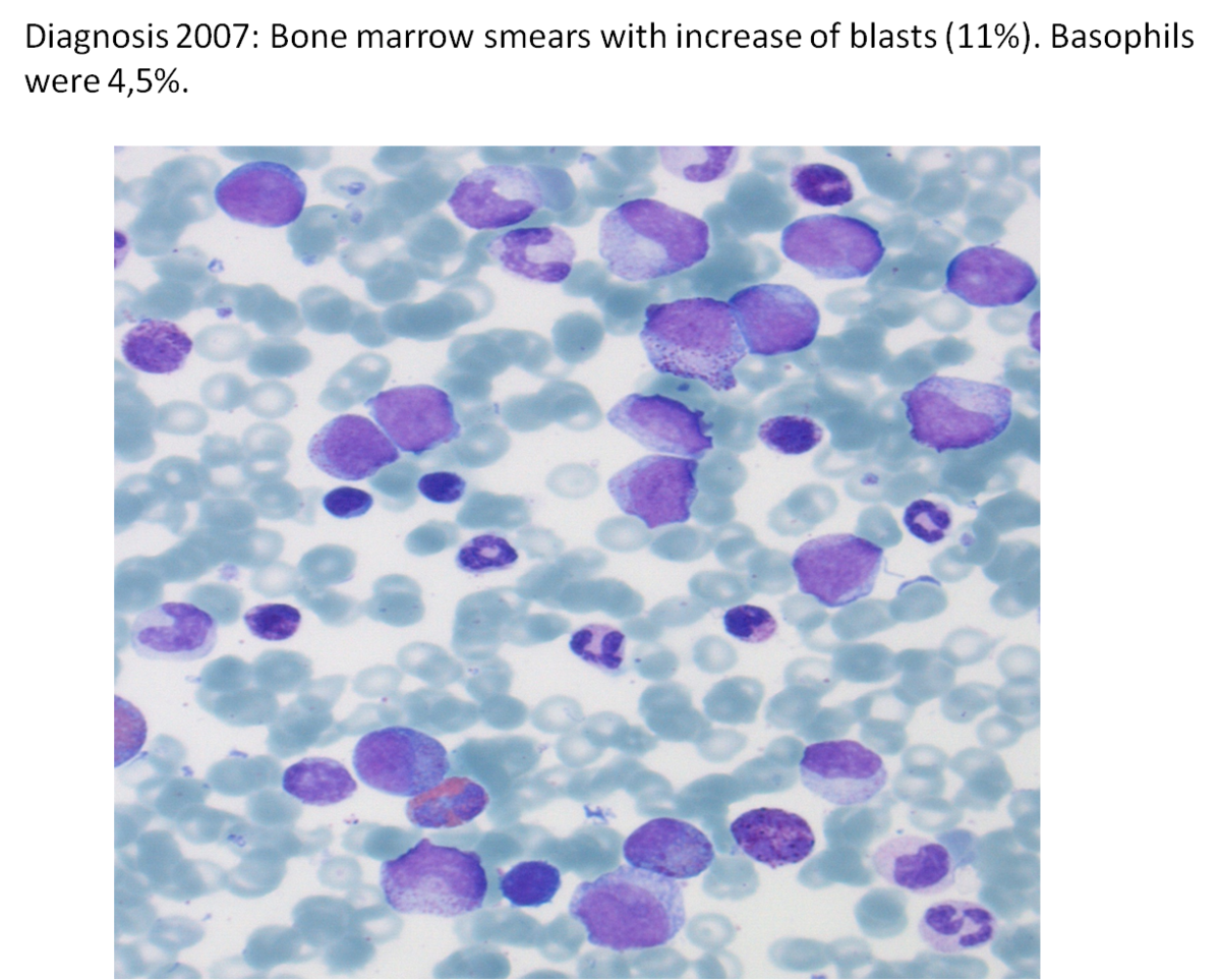 Fig 3. Bone marrow smear at diagnosis